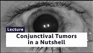 Conjunctival tumors in a nutshell