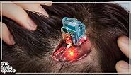 New Brain Implant Begins Human Trials - Neuralink Update!