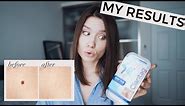 HOW TO REMOVE SKIN TAGS AT HOME FAST | Does Claritag Work? My Honest Review