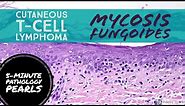Mycosis Fungoides (Cutaneous T-Cell Lymphoma): 5-Minute Pathology Pearls