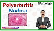 Polyarteritis nodosa - Definition, Epidemiology, Pathology ,Clinical features, Diagnosis, Treatment