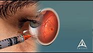 How Macular Degeneration Affects Your Vision - 3D animation