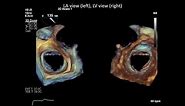 3D TEE of a Normal Mitral Valve