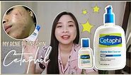CETAPHIL Gentle Skin Cleanser Review || Maganda ba sa acne prone skin? 🤔