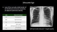 How to Interpret a Chest X-Ray (Lesson 8 - Focal Lung Processes)