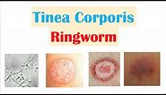 Ringworm (Tinea Corporis) | Causes, Risk Factors, Signs & Symptoms, Diagnosis and Treatment