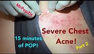 Dozens of clogged pores over the sternum extracted. Blackheads, whiteheads removed.