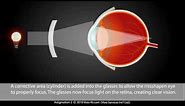 Astigmatism explained: Easily Corrected With A Cylinder in Your Eyewear Glasses