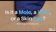 Is It a Mole, a Wart, or a Skin Tag?