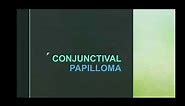 Conjunctival papilloma