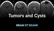 Tumors and Cysts: Brain CT scans of different conditions
