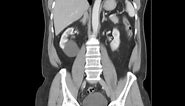 CT Abdomen with Renal Cyst and renal anatomy DISCUSSION by Radiologist