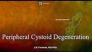 Peripheral Cystoid Degeneration. Peripheral Retinal Degenerations.