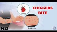 CHIGGERS BITE: Everything You Need To Know