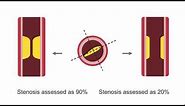 Assessing Lesion Severity in Coronary Angiography