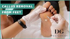 Callus removal from feet: balls of feet