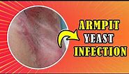How to treat Armpit yeast infection (Candida) at home