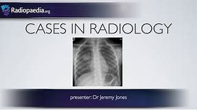 Cases in Radiology: Episode 3 (pediatric, chest x-ray)