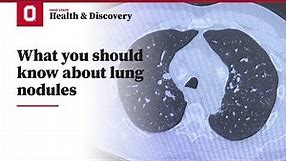 What you should know about lung nodules | Ohio State Medical Center