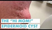 The "Hi Mom!" Epidermoid Cyst