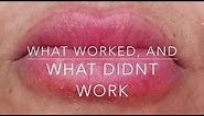Cure a LIP Allergy! Big swollen, cracked & painful lips!! What works, what doesn't