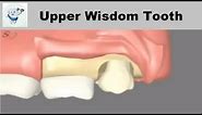 Upper Wisdom Tooth Removal
