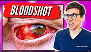 Bloodshot Eyes | What Causes Bloodshot Eyes and How to Get Rid of Them | Doctor Eye Health