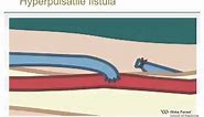 Physical Examination of Arteriovenous Fistula