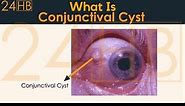 What Is Conjunctival Cyst | 24HB