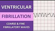 Ventricular Fibrillation (V-Fib) ECG Interpretation Nursing Heart Rhythms NCLEX ACLS