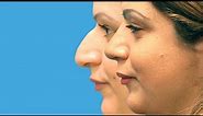Rhinoplasty: Before and After