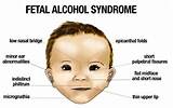 Signs Of Mental Retardation In Infants Images