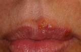 Symptoms For Herpes Pictures