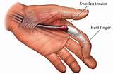 Pictures of Finger Cancer Symptoms
