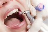 Images of Home Dental Cleaning