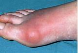 Photos of Gout Symptoms Big Toe