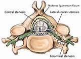 Pictures of Back Surgery Decompression