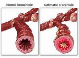 Chronic Inflammation Asthma