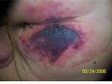 Photos of Pressure Ulcer Deep Tissue Injury Pictures