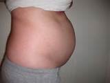 Severe Abdominal Bloating After Eating Photos
