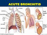 Images of X Ray Of Chronic Bronchitis