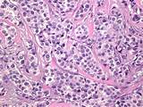Images of Carcinoma In Breast