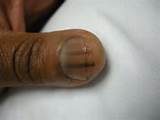 Fingernail Melanoma Pictures Photos