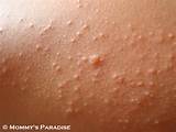 Images of Yeast Infection Symptoms Red Bumps