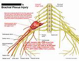 Nerve Damage Brachial Plexus Pictures