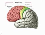 Frontal Lobe Brain Tumor