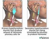 Photos of Pituitary Tumor Hypothyroidism