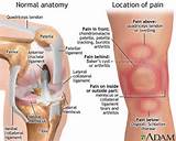 Knee Pain Nerve Damage Symptoms Images