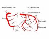 Coronary Artery Tree Diagram Pictures