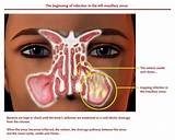 Nasal Spray Causes Cancer Photos